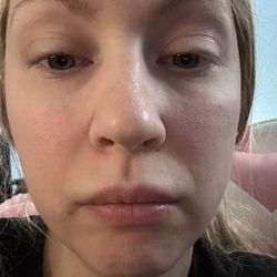 Esse Plastic Surgery - Top lip is plump