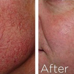 Messina Esthetic Medicine - Laser Treatment on Facial Veins