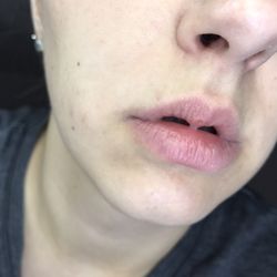 Ideal Image North Andover - STILL A FULL LIP OF HAIR. SO ANGRY