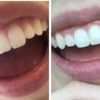 Naran Family Dentistry - Dr. Naran did an amazing job at fixing my chipped tooth -- color, size and all! - Oral Surgeons Near Me - Raleigh, North Carolina Naran Family Dentistry - Dr. Naran did an amazing job at fixing my chipped tooth -- color, size and all! - Oral Surgeons Near Me - Raleigh, North Carolina