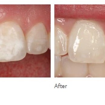City View Dental Studio - ICON Resin is a no-drill, no-fill treatment for white-spot lesions and congenital hypo-calcified enamel lesions. Call for more information! - Cosmetic Dentists Near Me - Albuquerque, New Mexico City View Dental Studio - ICON Resin is a no-drill, no-fill treatment for white-spot lesions and congenital hypo-calcified enamel lesions. Call for more information! - Cosmetic Dentists Near Me - Albuquerque, New Mexico