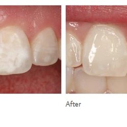 City View Dental Studio - ICON Resin is a no-drill, no-fill treatment for white-spot lesions and congenital hypo-calcified enamel lesions.  Call for more information!
