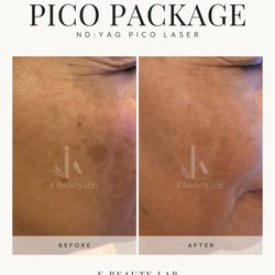 K Beauty Lab - ND:YAG Pico Laser | Pigmentation Treatment Before & After