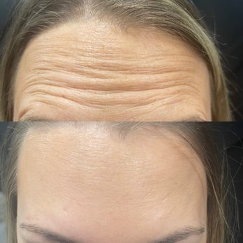 Revitalize RX Infusion + Med Spa - Botox - before and after - Estheticians Near Me - Dartmouth, Massachusetts Revitalize RX Infusion + Med Spa - Botox - before and after - Estheticians Near Me - Dartmouth, Massachusetts