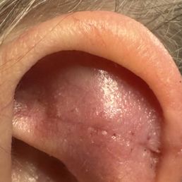 cut ear after stitches removal cut ear after stitches removal