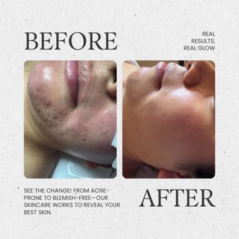 Aesthetic OOGII - Acne Treatment - Skin Care Near Me - San Francisco, California Aesthetic OOGII - Acne Treatment - Skin Care Near Me - San Francisco, California