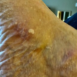 Inside of right foot from over-tight ski boot.