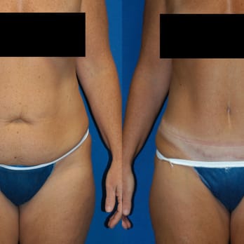 Brucker Plastic Surgery - Abdominoplasty - Cosmetic Surgeons Near Me - La Jolla, California