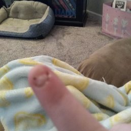This is my finger after the nail has been removed and it is starting to heal This is my finger after the nail has been removed and it is starting to heal