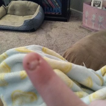 Neaman Plastic Surgery & Medi Spa - This is my finger after the nail has been removed and it is starting to heal - Medical Spas Near Me - Salem, Oregon Neaman Plastic Surgery & Medi Spa - This is my finger after the nail has been removed and it is starting to heal - Medical Spas Near Me - Salem, Oregon