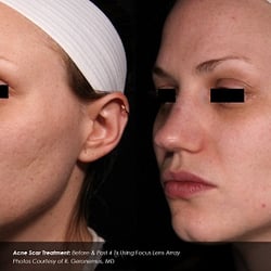Phoenix Tattoo Removal and Skin Revitalization
