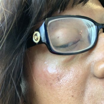 Bijou Nails & Spa - Swelling, pain and redness after face wax - Eyelash Service Near Me - Glendale, California Bijou Nails & Spa - Swelling, pain and redness after face wax - Eyelash Service Near Me - Glendale, California