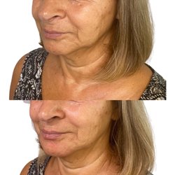 Truth Medical Aesthetics - Lower face dermal fillers