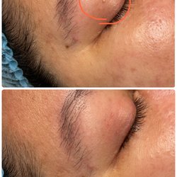 Pure Skin by Maggie - Experience the confidence that comes with clear, whitehead-free skin. Try our Whitehead Removal Solution today.