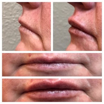 Christopher Mark Medspa - A comfortable nerve block is always performed so there will be no discomfort during treatment. Natural look regardless of age. - Medical Spas Near Me - Bellevue, Washington Christopher Mark Medspa - A comfortable nerve block is always performed so there will be no discomfort during treatment. Natural look regardless of age. - Medical Spas Near Me - Bellevue, Washington