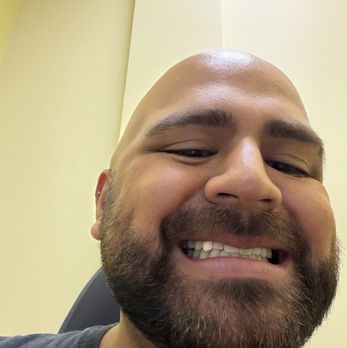X Dentistry - Front crown noticeably off. - General Dentistry Near Me - Tijuana, BCN X Dentistry - Front crown noticeably off. - General Dentistry Near Me - Tijuana, BCN