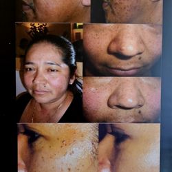 Beauty & Beyond Skin Care Center - Skin irregularities correction services before and after