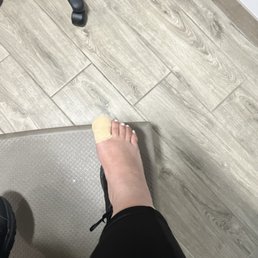 In office procedure. Protruding nail removal.