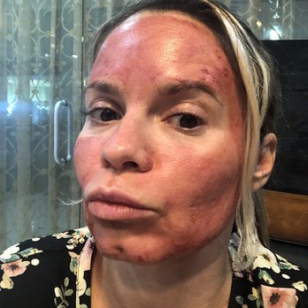 Ego Medical Aesthetics - Don't drink a lot of wine night before, you'll be extra bloody - Medical Spas Near Me - Gilbert, Arizona Ego Medical Aesthetics - Don't drink a lot of wine night before, you'll be extra bloody - Medical Spas Near Me - Gilbert, Arizona