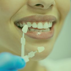 Greenspoint Dental - Veneers for a new smile.