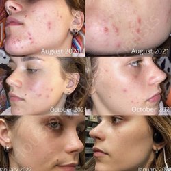 Houston Acne Specialists