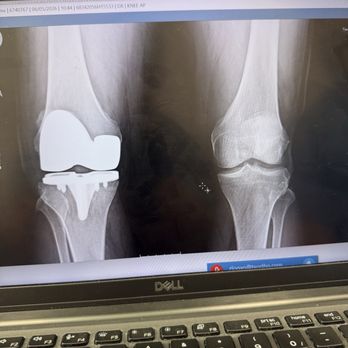 Texas Orthopedics - After the surgery. No more arthritis!!! - Diagnostic Imaging Near Me - Leander, Texas Texas Orthopedics - After the surgery. No more arthritis!!! - Diagnostic Imaging Near Me - Leander, Texas