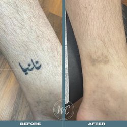 Wesley Chapel Laser and Aesthetics - Before and After 3 sessions of tattoo removal.
