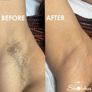 Shobha - Before Sugaring: Underarm area with noticeable hair growth. After Sugaring: Smooth, hair-free underarm. - Waxing Near Me - Washington, DC, District of Columbia Shobha - Before Sugaring: Underarm area with noticeable hair growth. After Sugaring: Smooth, hair-free underarm. - Waxing Near Me - Washington, DC, District of Columbia