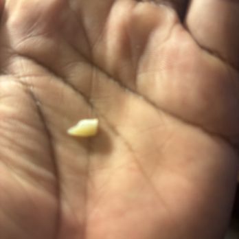 Tsu Ping Chen,DDS - The piece of tooth that broke off - General Dentistry Near Me - Fresno, California