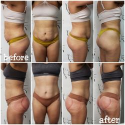 Embodee'd Aesthetics Beauty & Wellness - Ultimate waist and booty combo