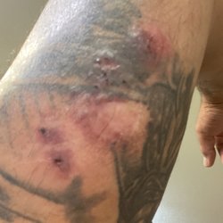 Tampa Bay Endoscopy Center - All scar tissue now red, agitated, and inflamed. All of this was healed scar tissue