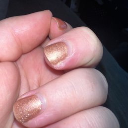 Infected nail Infected nail