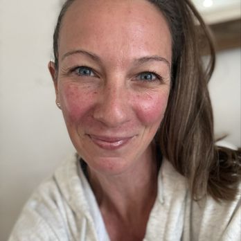 V Aesthetics - 1hr post PDRN Microneedling Facial! - Medical Spas Near Me - Walnut Creek, California V Aesthetics - 1hr post PDRN Microneedling Facial! - Medical Spas Near Me - Walnut Creek, California