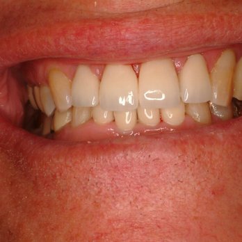 Albert Lee, DDS - After...Very happy customer! - General Dentistry Near Me - Indian Wells, California Albert Lee, DDS - After...Very happy customer! - General Dentistry Near Me - Indian Wells, California