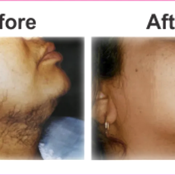 Flawlessly Ever After Electrolysis - Hair Removal Near Me - Addison, Texas Flawlessly Ever After Electrolysis - Hair Removal Near Me - Addison, Texas