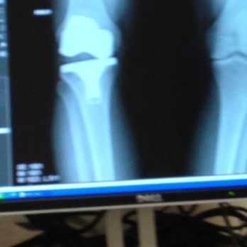 Barry A. Ruht, MD - This is a X-ray that Stevie Wonder could read Dr Ruth however never had the balls to tell me something might be wrong. - Orthopedists Near Me - Allentown, Pennsylvania