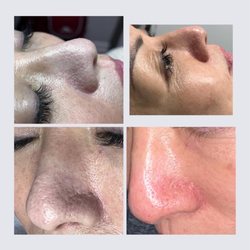 Luxury Beauty Studio & Academy - Shrink pore and smooth out the skin by Cool Jet technology