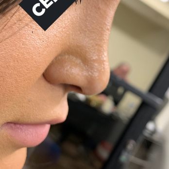 Esthetica - After!!! love my nose thanks Dr Kouli - Medical Spas Near Me - Coronado, California Esthetica - After!!! love my nose thanks Dr Kouli - Medical Spas Near Me - Coronado, California
