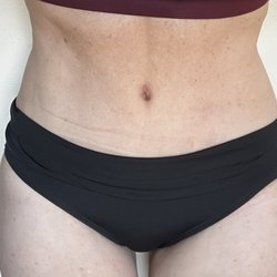Anureet K Bajaj, MD - Bajaj Plastic Surgery - 3 months post op