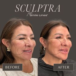 Profile Aesthetics - Sculptra Before and 6 mos After
