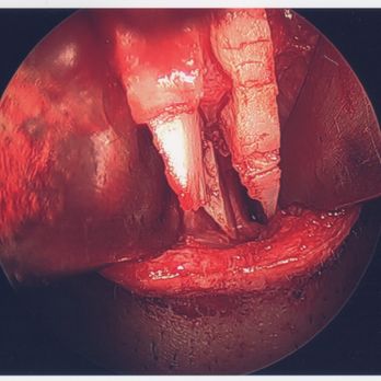 Ari Hyman, MD - His unnecessary/deviated grafts - Cosmetic Surgeons Near Me - Encino, California