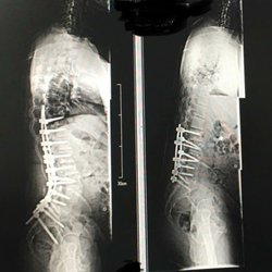 Orthopedic Specialists of Oakland County - The left side is what was needed to correct the hot mess on the right.