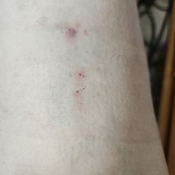USA Vein Clinics - The puncture holes left after the doctor kept moving the needle around cuz he couldn't get it in the right spot!