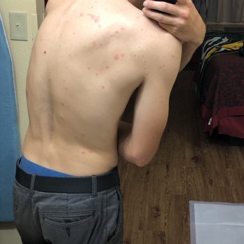 Motel 6 - Bed bug bites from motel 6 in Boerne - Hotels Near Me - Boerne, Texas Motel 6 - Bed bug bites from motel 6 in Boerne - Hotels Near Me - Boerne, Texas