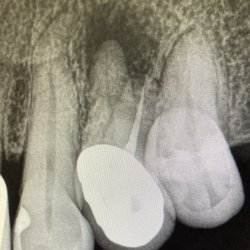Assogna Endodontic Speciality Group DDS - #12 tooth, first upper left bicuspid, only one of the root's was "fixed" the other became infected and had to be corrected