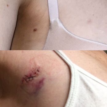 Tien Q Nguyen, MD, FAAD - This is what Dr Tien Ngyuen did to me, literally butchered me to remove this tiny mole. Stitches are so tight I cannot use my arm. - Immunodermatologists Near Me - Irvine, California Tien Q Nguyen, MD, FAAD - This is what Dr Tien Ngyuen did to me, literally butchered me to remove this tiny mole. Stitches are so tight I cannot use my arm. - Immunodermatologists Near Me - Irvine, California