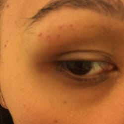 New York Thread - Red spots left from painful threading
