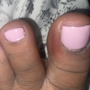 Savy Nail - My infected toe - Nail Salons Near Me - Upland, California Savy Nail - My infected toe - Nail Salons Near Me - Upland, California