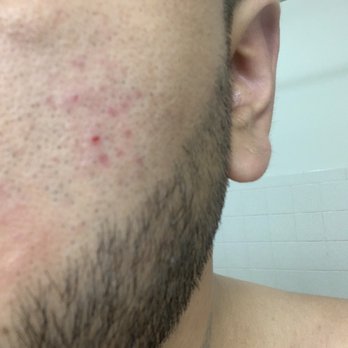 Tight Cuts - Rash after shave! - Barbers Near Me - Seattle, Washington Tight Cuts - Rash after shave! - Barbers Near Me - Seattle, Washington