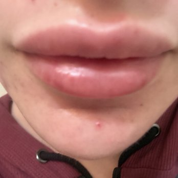 NakedMD - 1ml one day after (now 2ml in my lips) - Medical Spas Near Me - Burbank, California NakedMD - 1ml one day after (now 2ml in my lips) - Medical Spas Near Me - Burbank, California